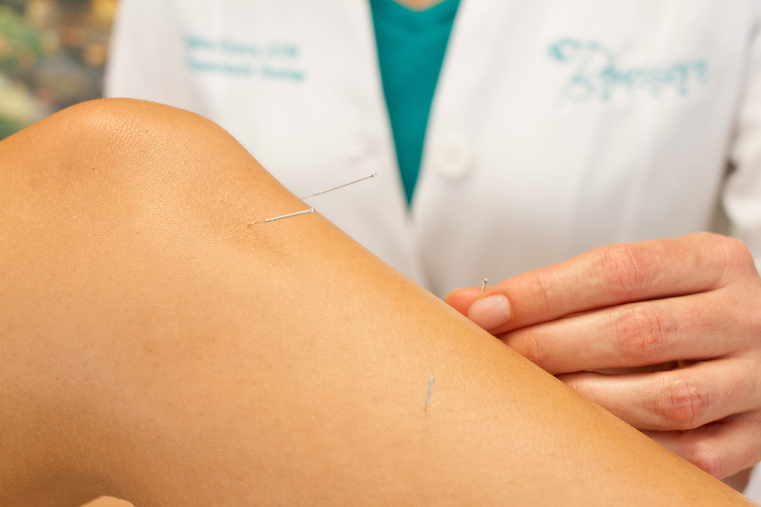 Photo acupuncture leg img 2803