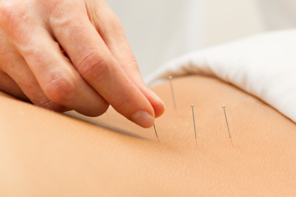 Photo acupuncture lower back img 2756